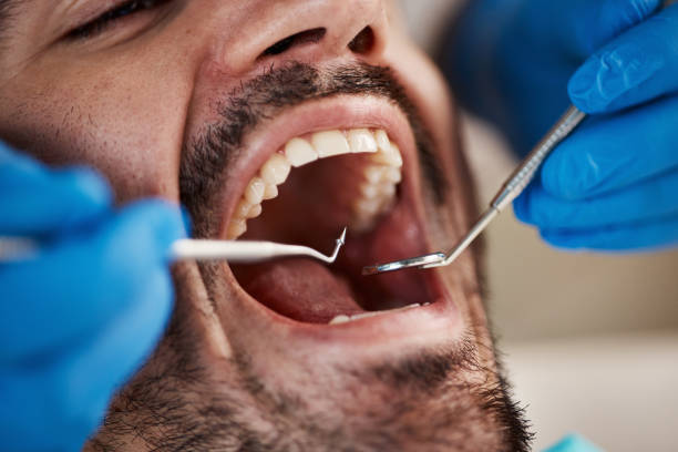 Best Emergency Dentist for Lost Fillings or Crowns in Millersville, TN